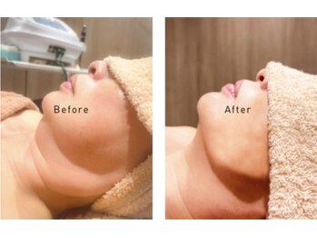 アンジュマリー/脂肪分解で二重アゴ撃退！