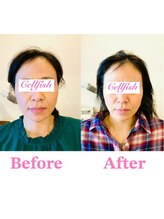 セルフィッシュ(Cellfish)/エラ張りや眉間のシワの改善に！