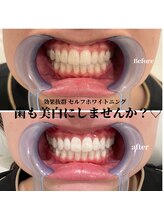 サロン ド リリー(salon de lily)/セルフホワイトニング