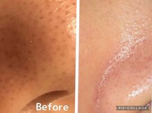 ワ(Wa)/ハイドロ毛穴洗浄