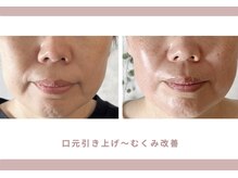 ロジワール(LOISIR)の雰囲気（小顔リフトアップ/たるみ/むくみ/小顔/ほうれい線/もたつき/）