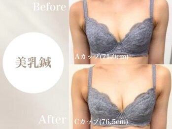 Onはり灸サロン/バストUP美乳鍼before→after