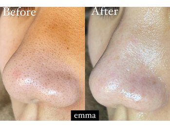 エマ(emma)/ハーブとエクストラクション