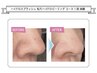 他メニューとのセット価格◎ハイドロスプラッシュ毛穴洗浄（鼻のみ）