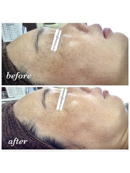 ラヴィソンファム(Ravissant femme)/40代１回効果/シワシミ改善