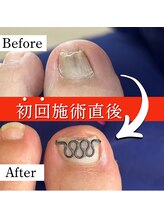 巻き爪矯正センター 沖縄 宜野湾/巻き爪矯正ビフォーアフター