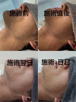 モエンド(MOEND)/ダウンタイムの参考