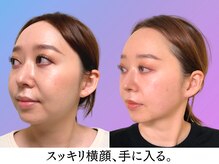 ナチュラルビューティーフェイス 横浜(NBF)/Before&After