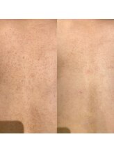 リベル 名古屋(Lebelle:)/ハーブピーリング　名古屋