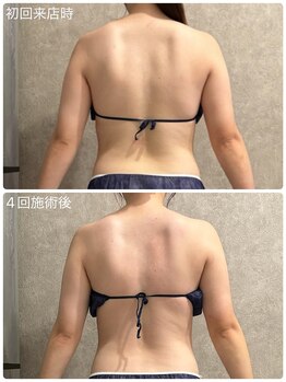 トータルビューティー ミミ(Total Beauty mimi)/ウェディングフォト前に美背中に