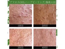 ラプリ 仙台店(Raplit stella)/ハーブピーリング/ニキビケア