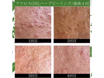 ラプリ 仙台店(Raplit stella)/ハーブピーリング/ニキビケア