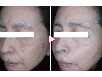 マイン イオンモール浜松市野店/ドクターリセラADS美肌活性