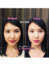 きらめき ワンライフ 川口(One Life)/小顔矯正BeforeAfter５