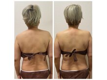 50代4回目比較、肩首こり、頭痛、だるさ、むくみ☆インディバ☆