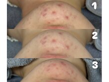 クリスタルビューティ 渋谷/【LHALALAララピール】