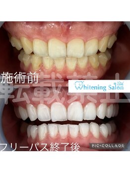 ホワイトニングサロン 名古屋 栄店/【ホワイトニング】