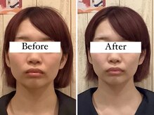 スピード小顔 渋谷店 (Speed)/体験ビフォーアフター