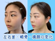 ナチュラルビューティーフェイス 横浜(NBF)/横顔も変わる小顔矯正/横浜小顔