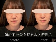 チョコバリ 郡山店(chocobari)/小顔×リフトアップ(美容鍼)20代