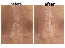 リベルタ/毛穴・黒ずみ・くすみ