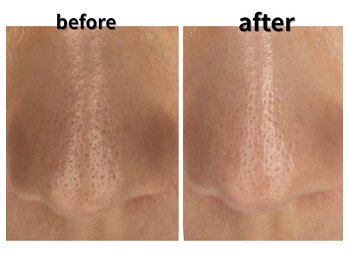 リベルタ/毛穴・黒ずみ・くすみ