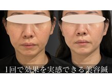 チョコバリ 中目黒店(chocobari)/小顔×リフトアップ(美容鍼)40代