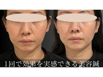 チョコバリ 中目黒店(chocobari)/小顔×リフトアップ(美容鍼)40代