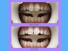 ココティ ホワイトニング(Cocotii)/ビフォーアフター