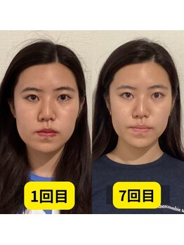 パンダ(Panda)/顎歪み矯正