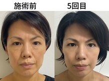 シアワセ(shiAwase)/【大阪本町】小顔矯正　B/A変化