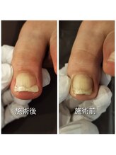 立川巻爪補正院/巻き爪　初回の術前・術後