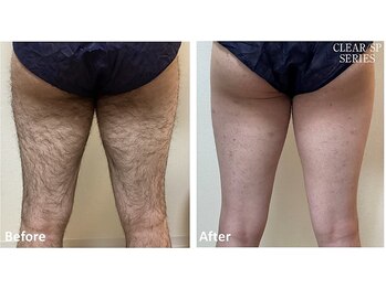 セラス(CERAS)/男性の足脱毛