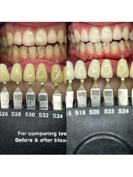トウキョウスワーズ 池袋店(TOKYO SWRS)/#ホワイトニング #池袋 #渋谷