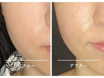 クク 赤坂 天神(99 KUKU)/20代/エラの凝り解消