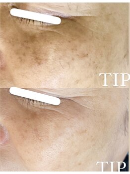 ミエル(miel)/【シミケア×ハーブピーリング】