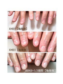 オハナブルーム バイ リリー(ohana bloom by Lily)の写真/深爪・チビ爪・爪が薄いなど。コンプレックスを解消できる自爪に優しい施術のパラジェル登録サロン♪