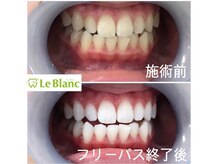 ルブラン 奈良店(Le Blanc)/ムラなく綺麗な歯に！
