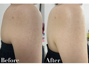 ビジュー(美柔 Bijou)/REVI剥離なしハーブピーリング