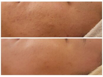 エントテ(en to Te)/ニキビケアもエクストラクション