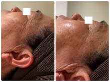 ビーグレイス(Vigrace)/ララピール/目元のシワに◎