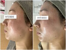 ホリシア 博多(HORISHIA)/ハーブピーリング/ニキビケア