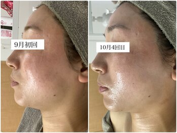 ホリシア 博多(HORISHIA)/ハーブピーリング/ニキビケア