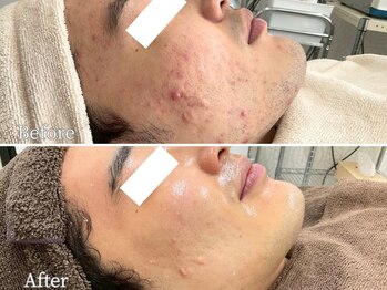 ニキビケア研究所 池袋店/メンズのニキビ悩みにも◎