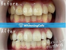 ホワイトニングカフェ 豊中店(WhiteningCafe)/◎歯のホワイトニング施術写真◎
