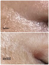 ひびき 京都烏丸御池店/プラズマ＋EMS小顔フェイシャル