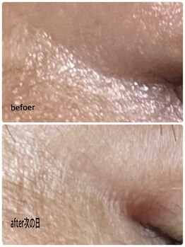 ひびき 京都烏丸御池店/プラズマ+EMS小顔フェイシャル