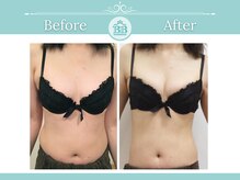 美人バスト 新宿店/☆バストアップ症例写真☆