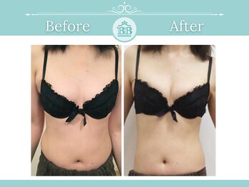 美人バスト 新宿店/★バストアップ症例写真★