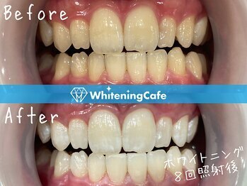 ホワイトニングカフェ赤羽店/ホワイトニングビフォーアフター